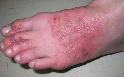allergic_contact_dermatitis.jpg